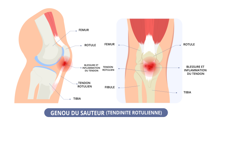 Bandage Rotule Thuasne Sport – tendon rotulien – nouvelle gamme – Image 4